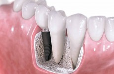 implantes dentales