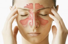 sinusitis