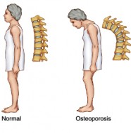 osteoporosis
