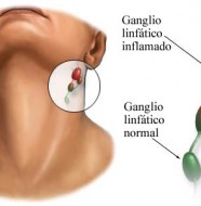 ganglios linfáticos