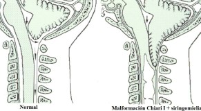 malformacion de chiari diferencia