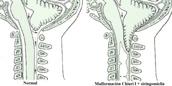 malformacion de chiari diferencia