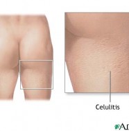 celulitis
