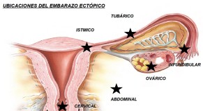 embarazo ectopico imagen